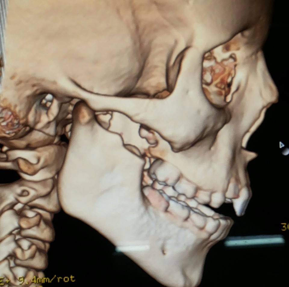 Tratamento/cirurgia da ATM