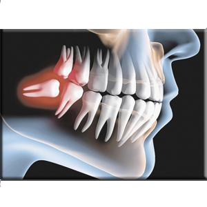 Dentes Inclusos/Siso