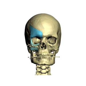 Reconstrução Craniofaciais